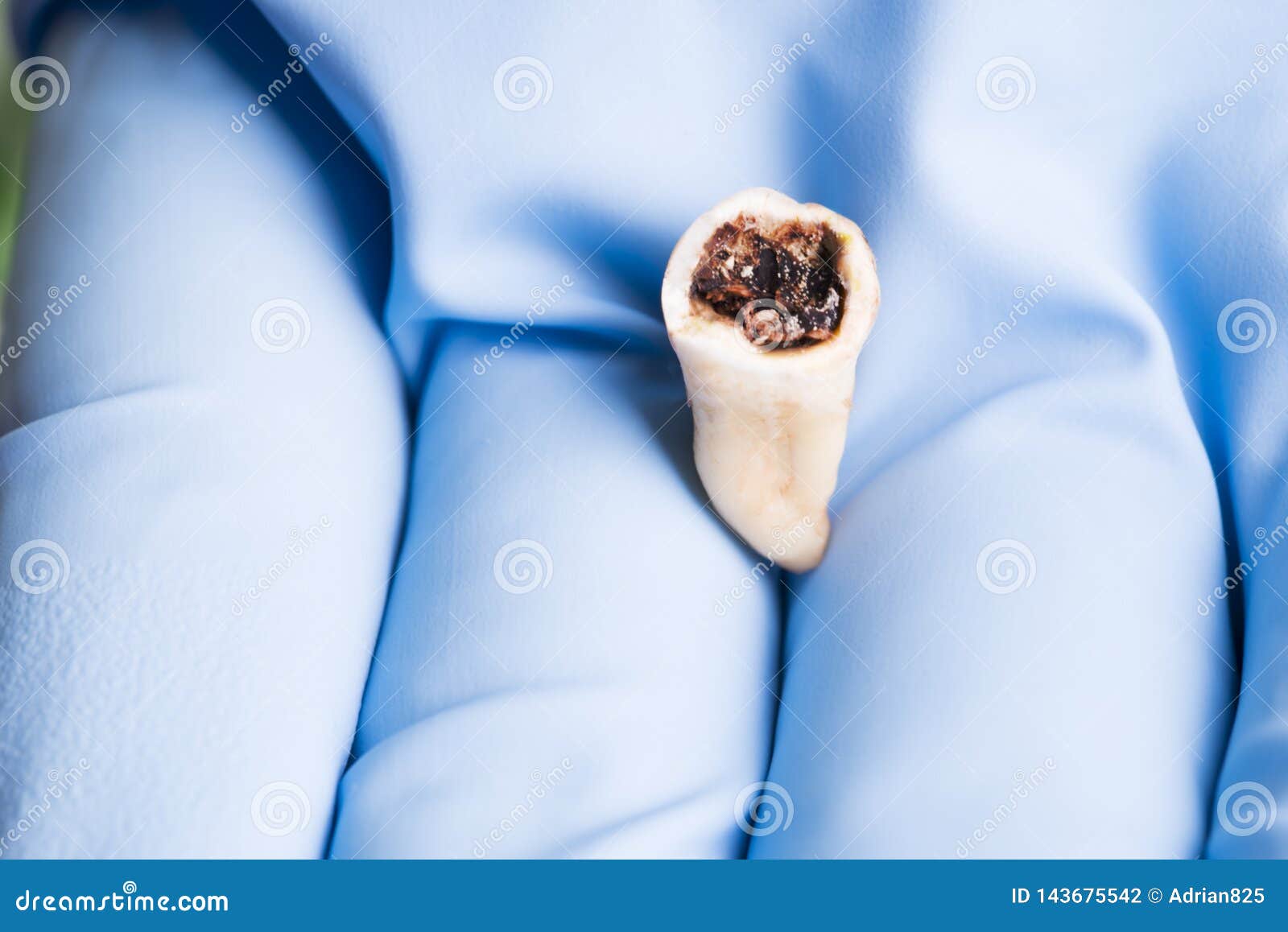 extracted rotter molar  in dentistÃ¢â¬â¢s hand with blue medical glove